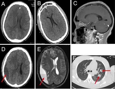 Rare brain and pulmonary abscesses caused by oral pathogens started with acute gastroenteritis diagnosed by metagenome next-generation sequencing: A case report and literature review